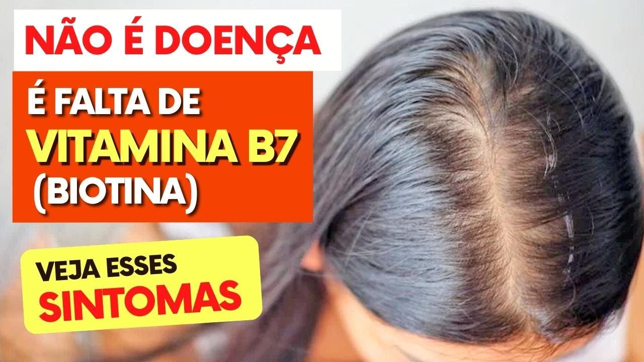 N O Doen A Falta De Vitamina B Biotina Voc Est Sentindo Isso